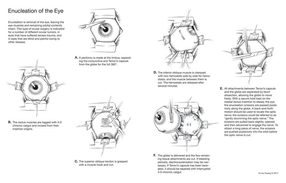 enucleation